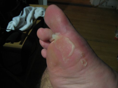 blister.jpg